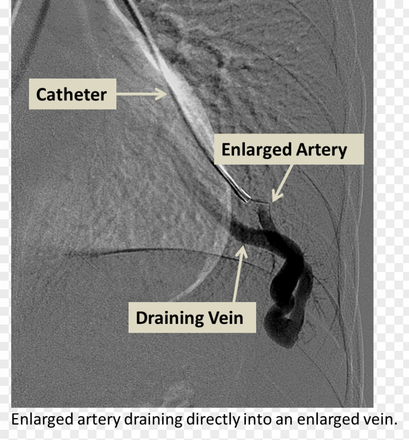 Pulmonary Vein Cerebral Arteriovenous Malformation Lung Embolization Angiography PNG