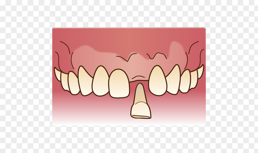 Dental Bridge 審美歯科 Dentist Dentures Technician PNG